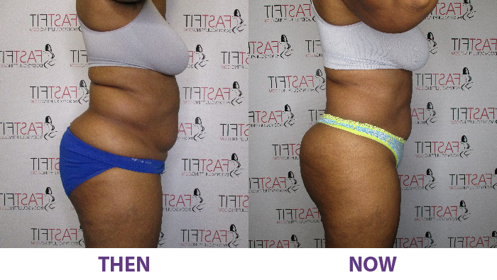 before and after fast fit desiree