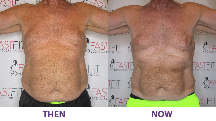 before and after fast fit walter