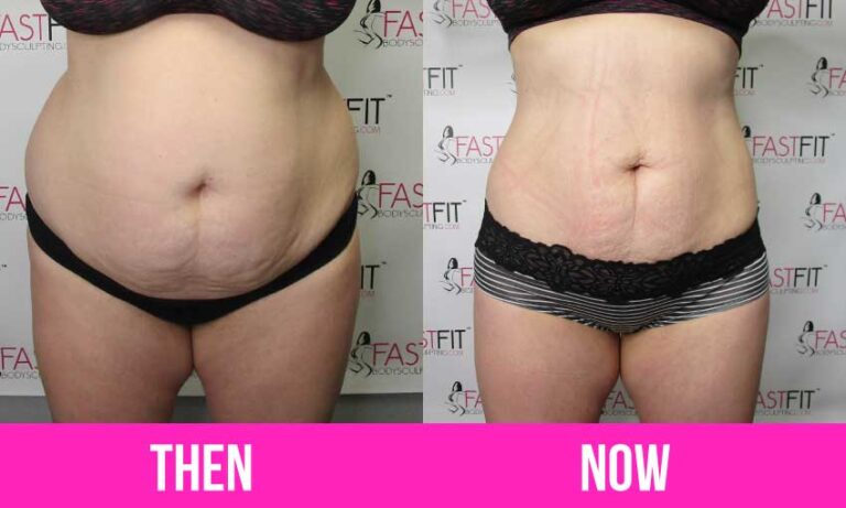 Surgical Vs Non Surgical Body Contouring Fast Fit Body Sculpting